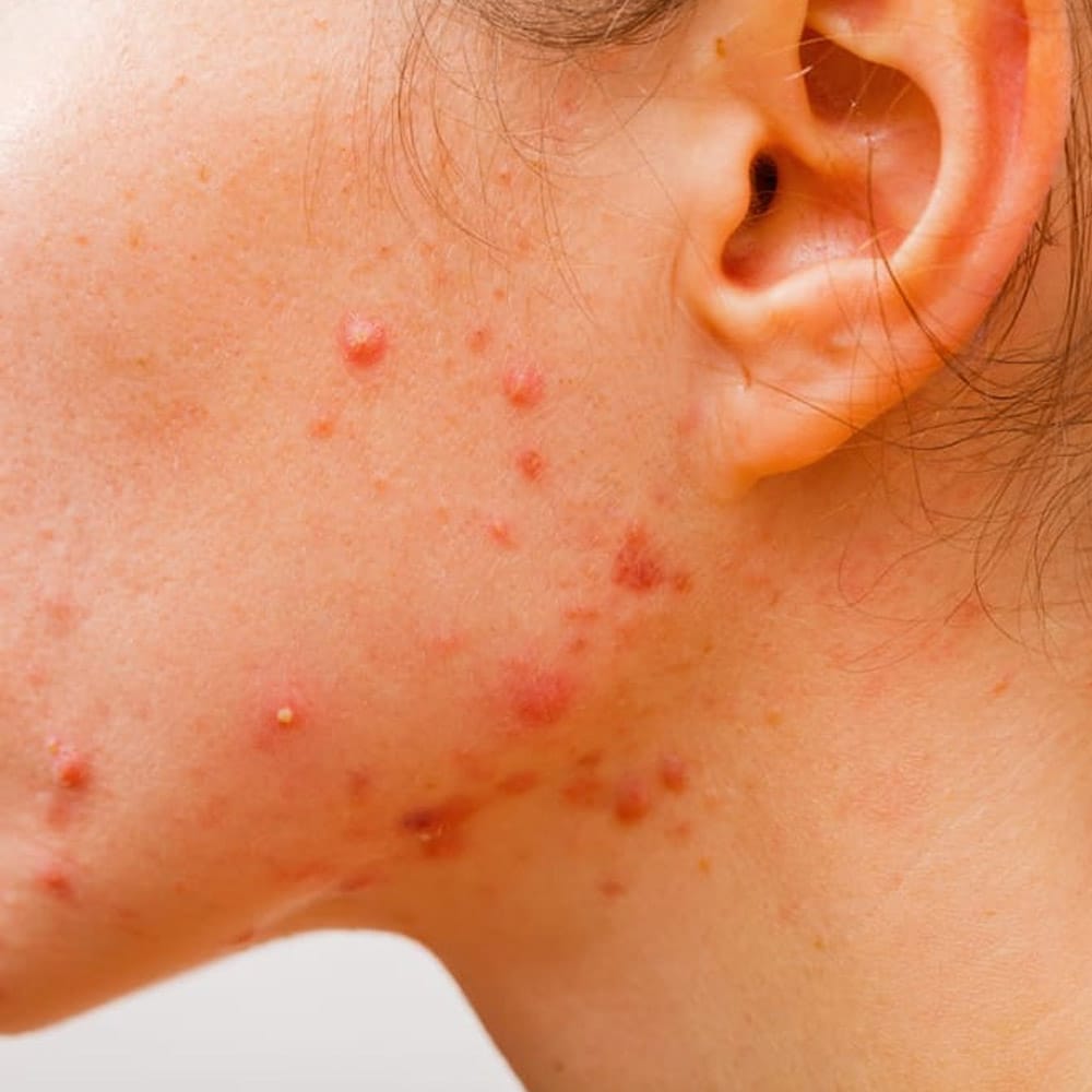 acne skin condition