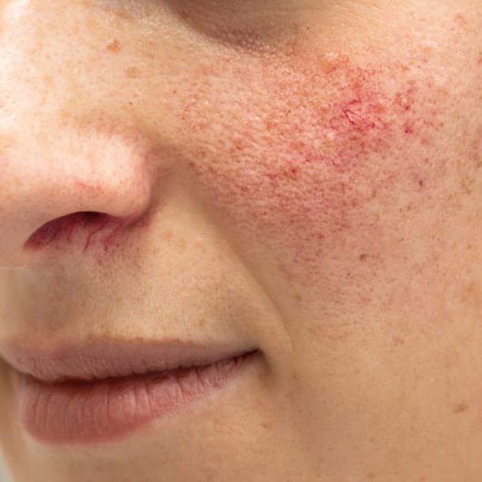 rosacea skin condition
