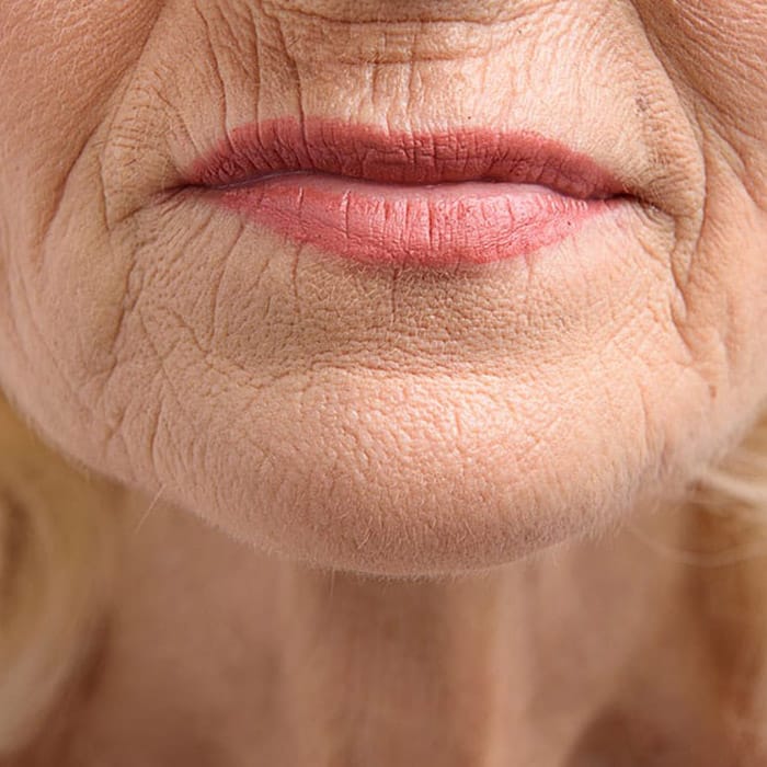fine lines and wrinkles caused by smoking
