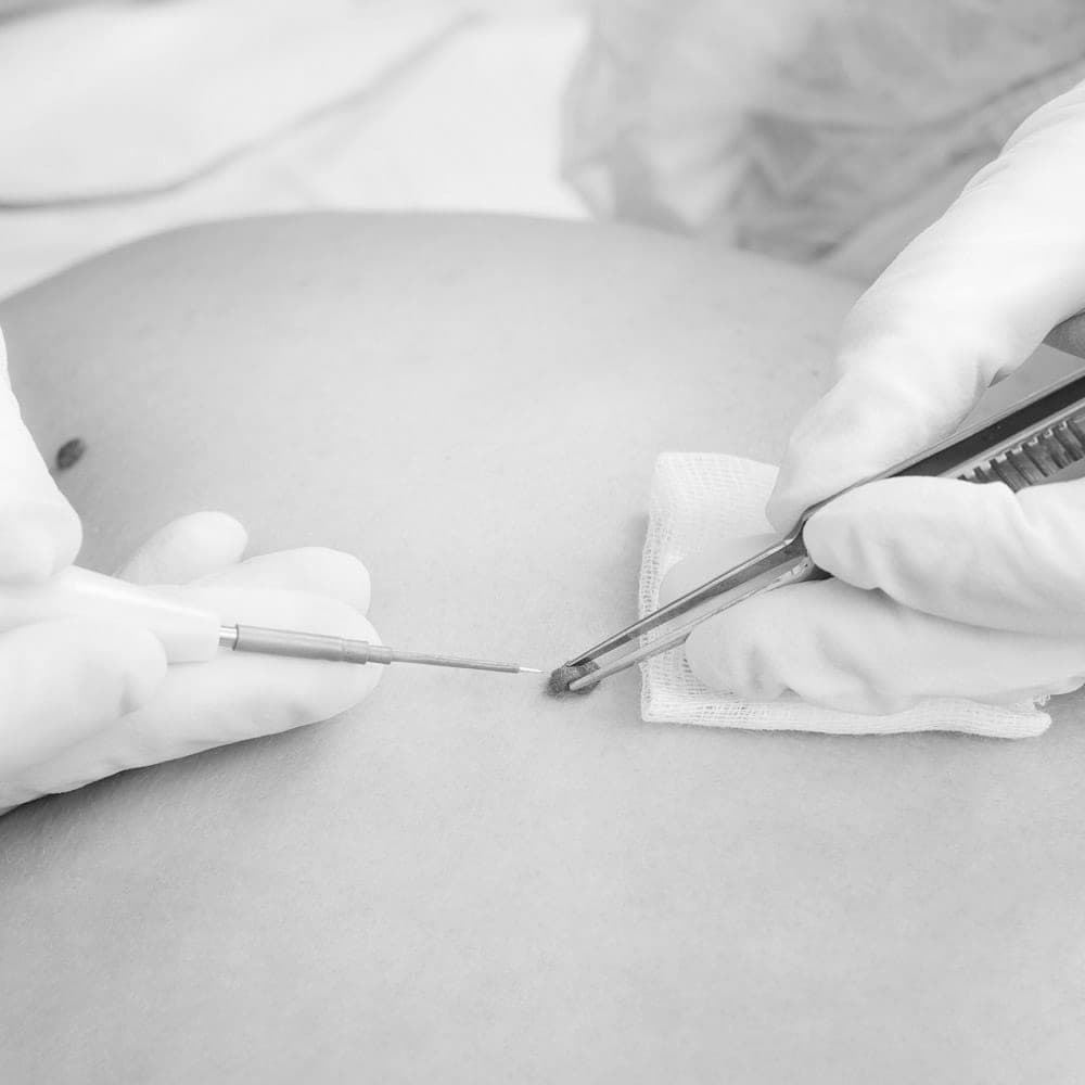 Hypercation Hyfrecation - Facial Aesthetics