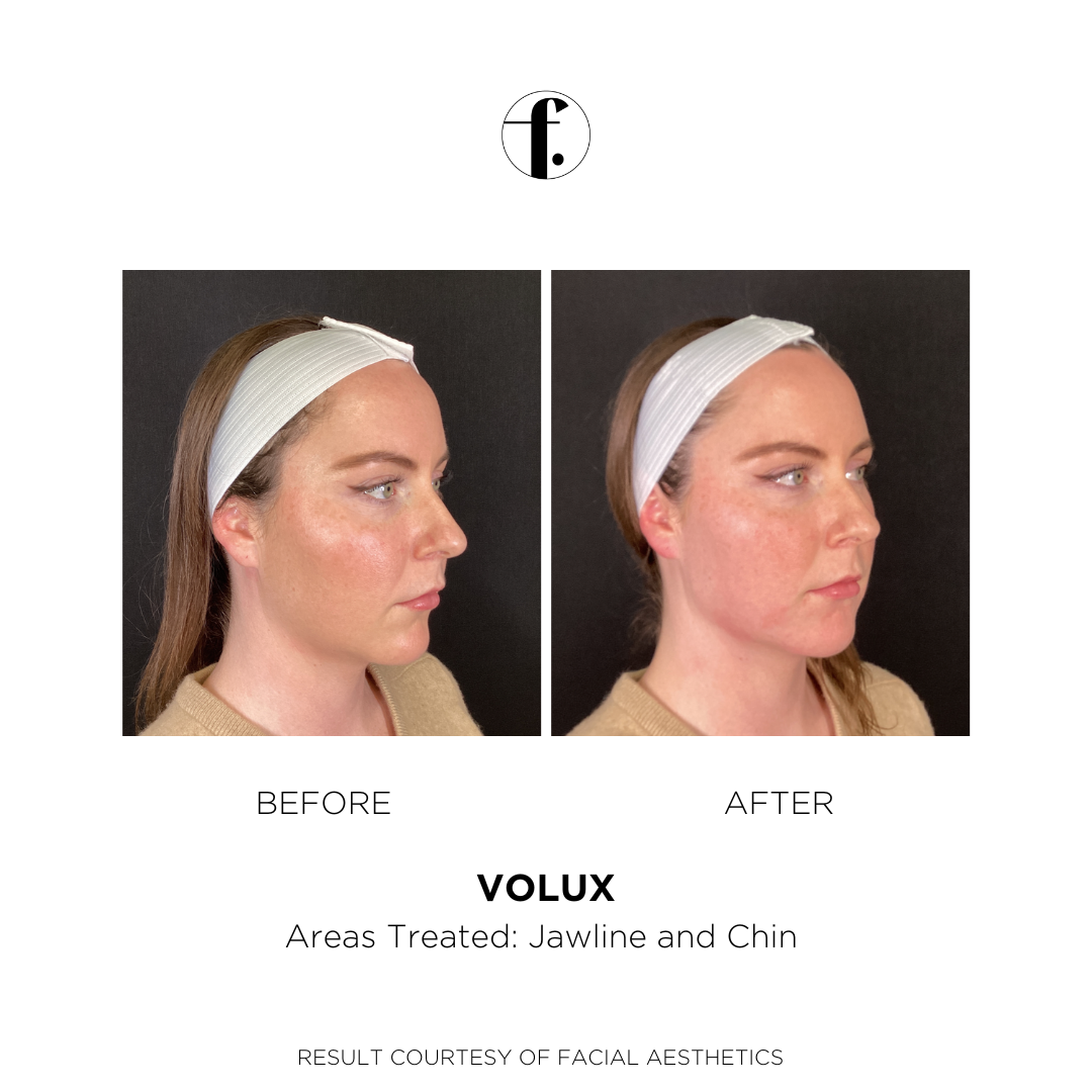 Female Volux Before and After 3