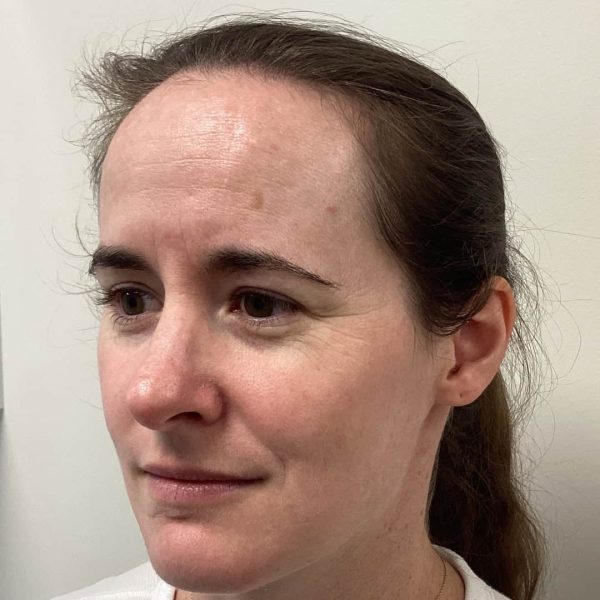 CoolPeel-After.jpg