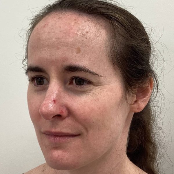 CoolPeel-Before.jpg